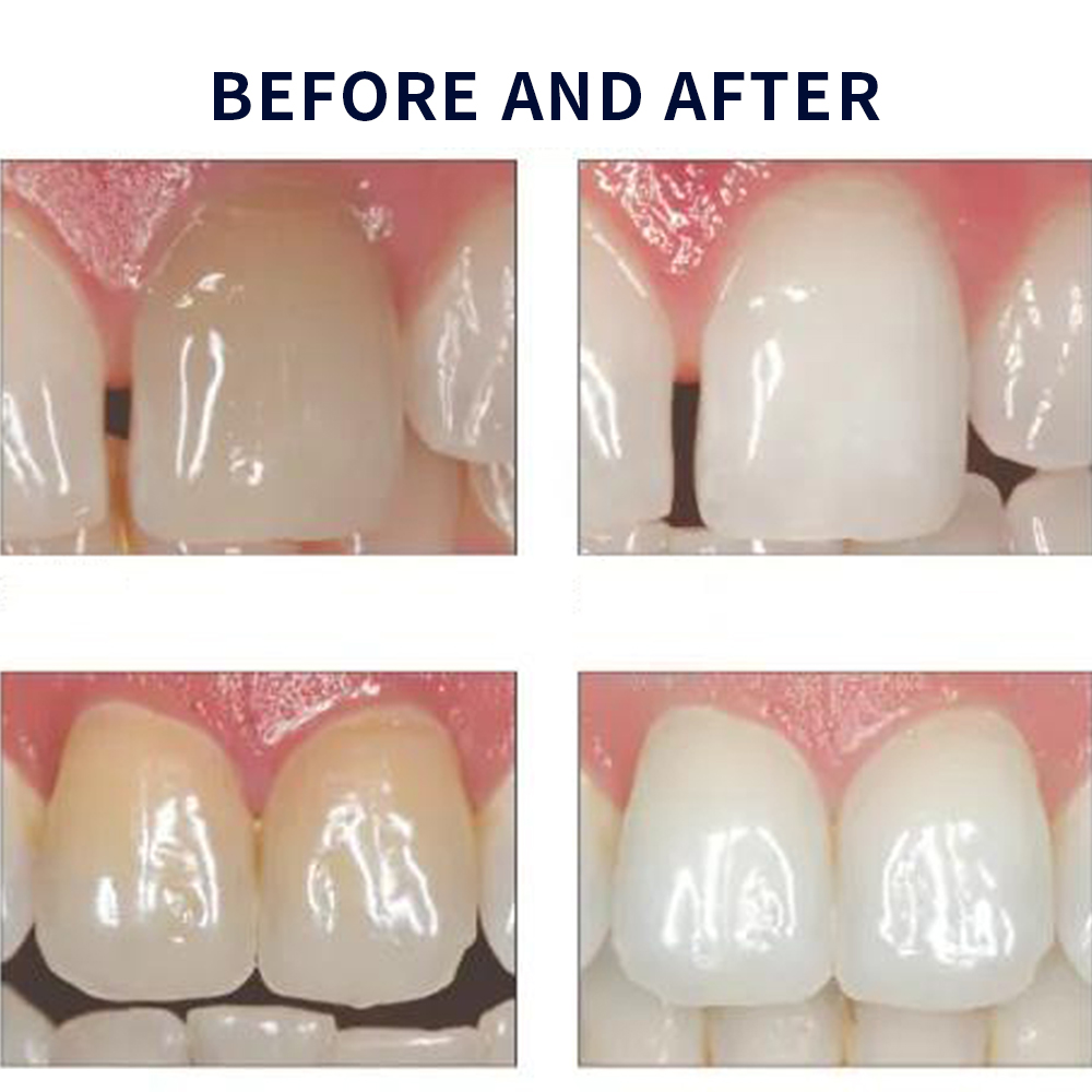Opalescence Whitening 20% PF 2 - Teeth Whitening Price ulasan dan harga