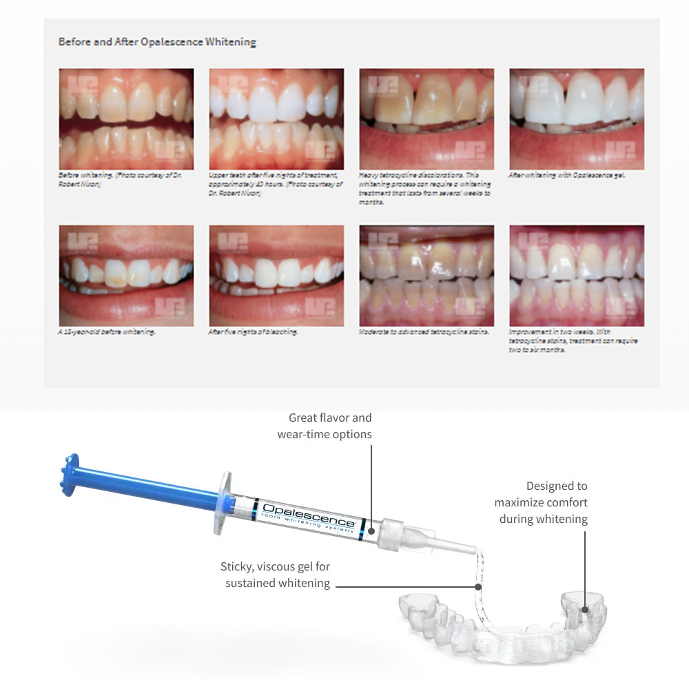 Opalescence Whitening 20% PF 2 - Teeth Whitening Price ulasan dan harga